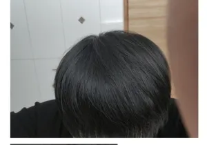 모발이식에 천만원 투자한 결과.jpg